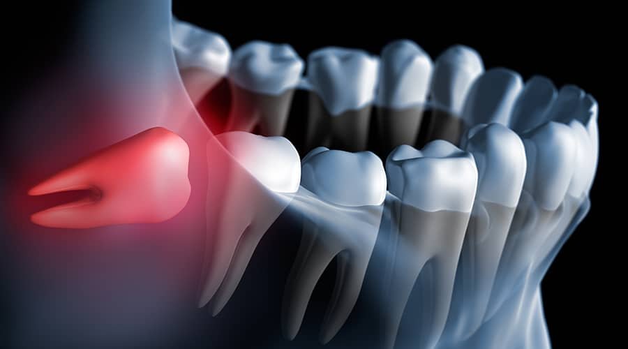 Oral and Maxillofacial Surgery Wisdom Teeth Extraction