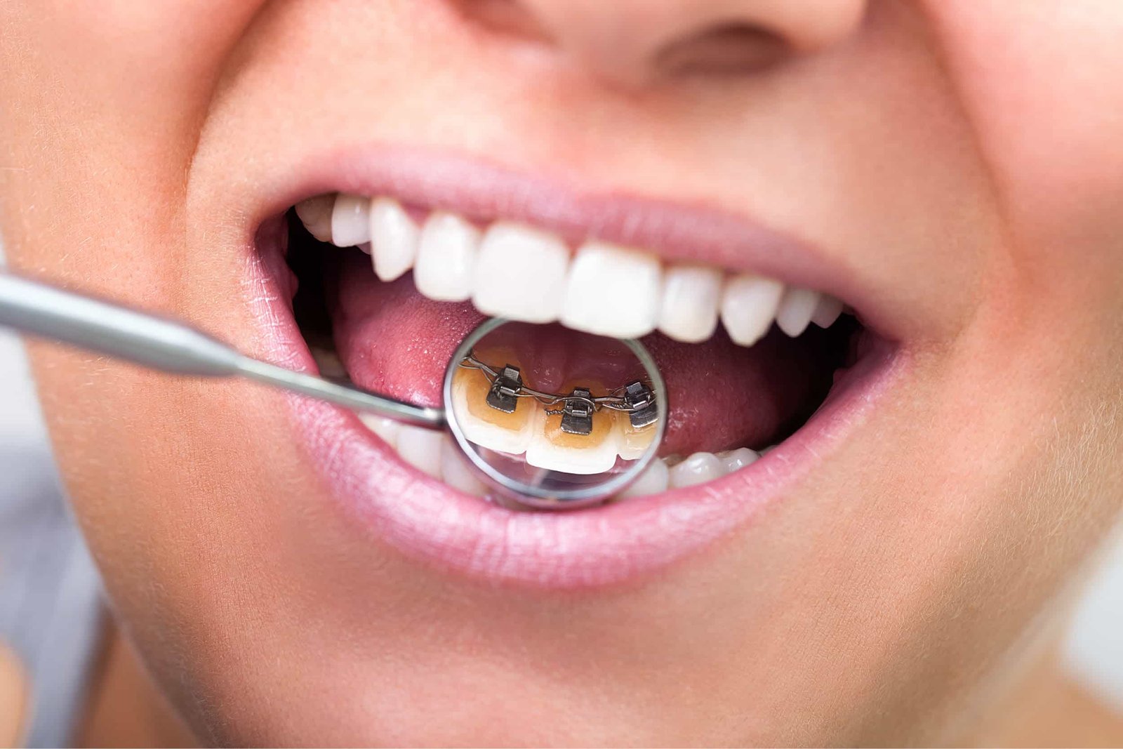 Discreet Lingual Braces Orthodontics