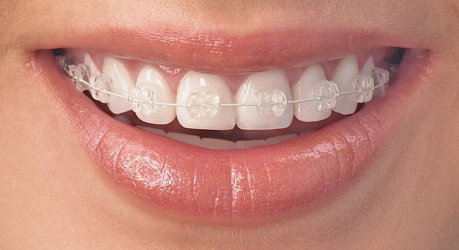 Metal & Ceramic Braces