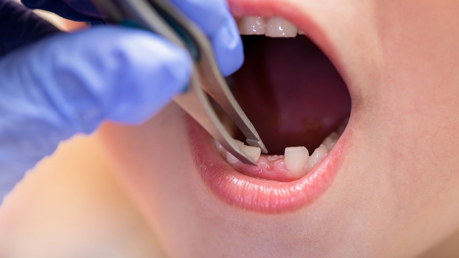 Milk Tooth Extraction