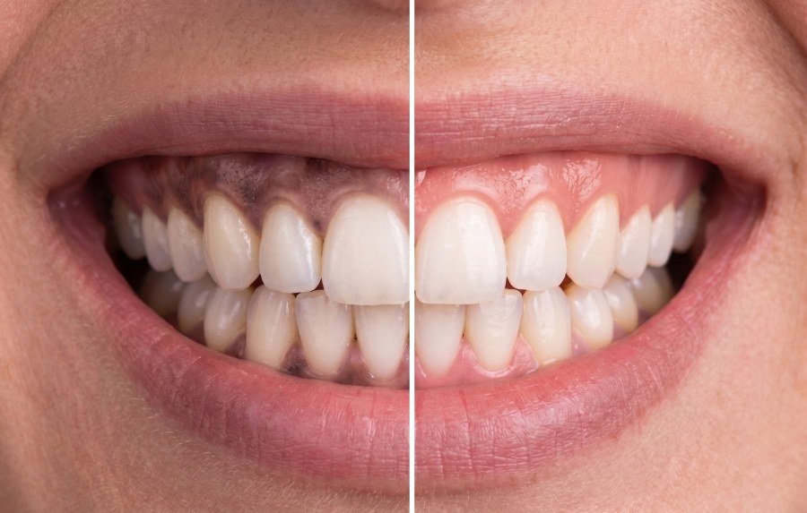 Laser Gum Depigmentation