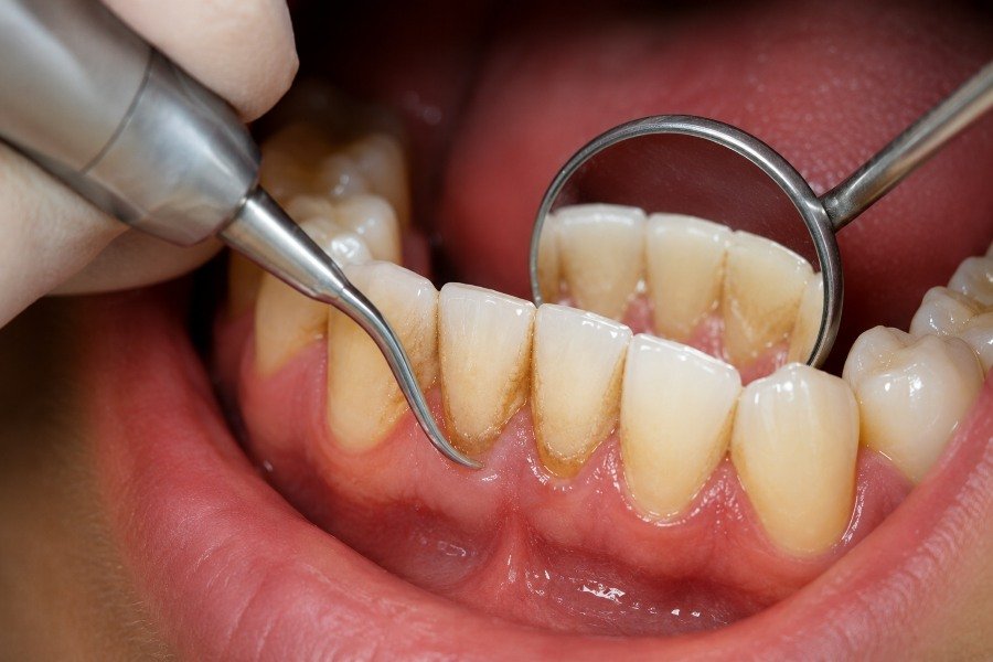 Gum Cleaning / Deep Cleaning